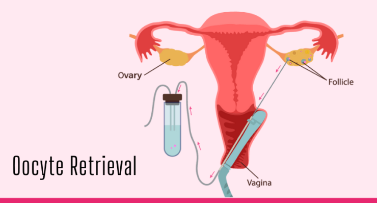 Oocyte Retrieval