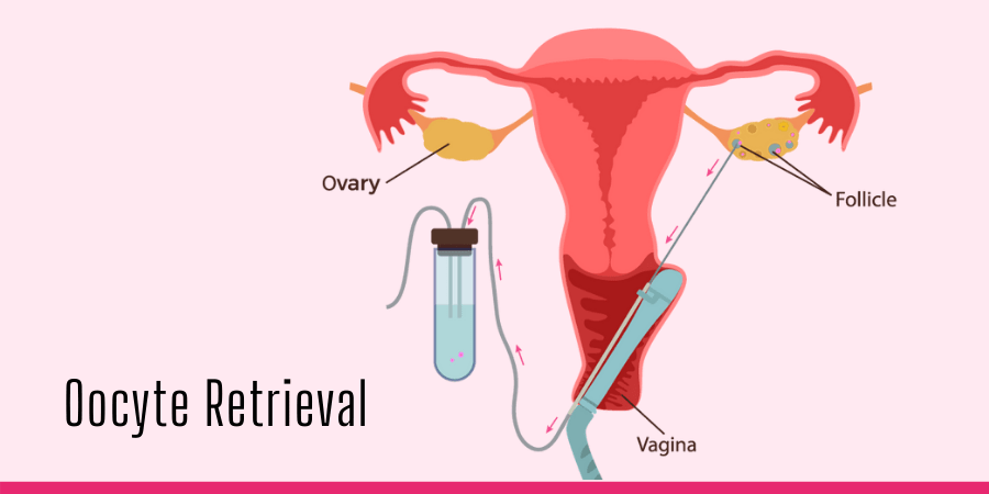 Oocyte Retrieval